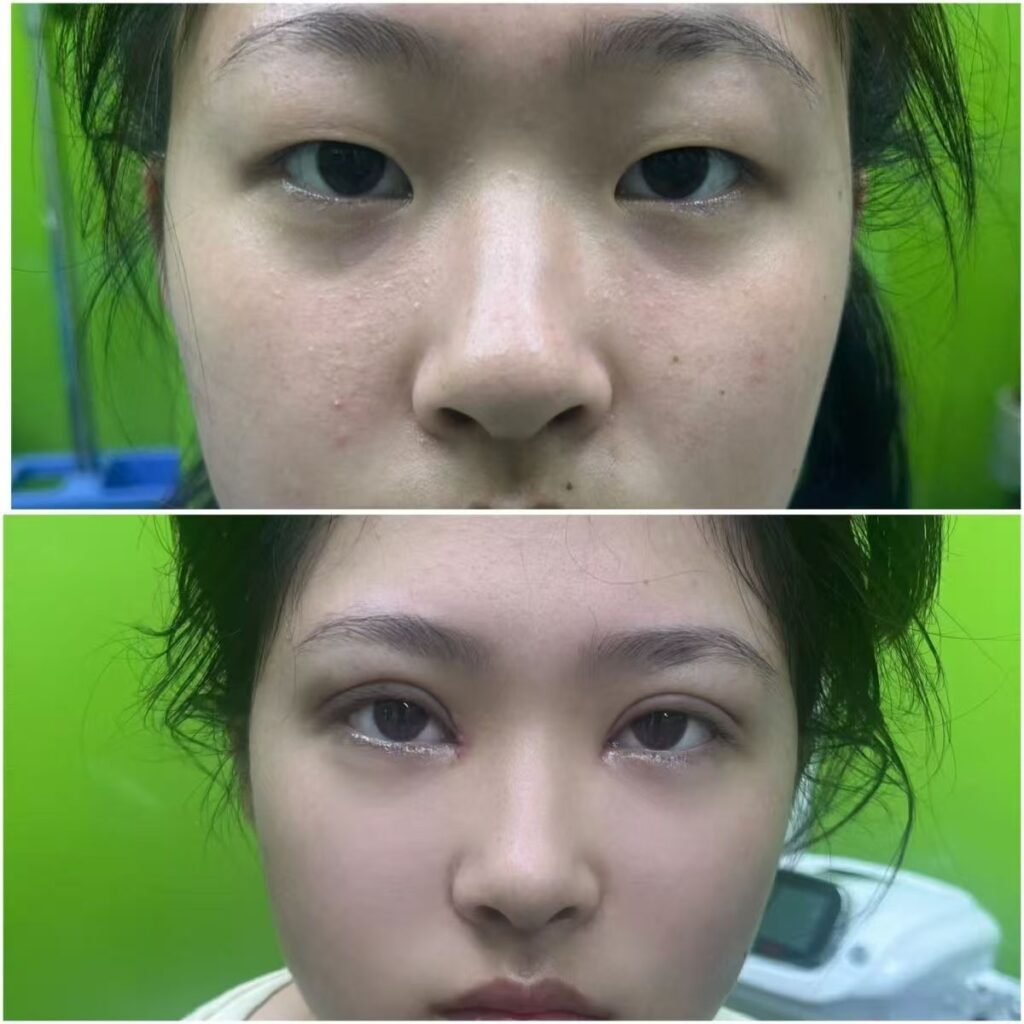 View Angle: Right-Side 双眼皮 | Dr. Hu Case