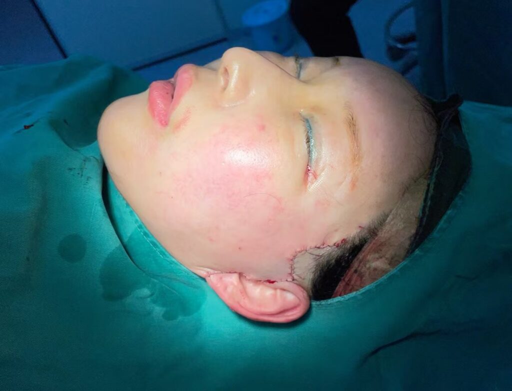 View Angle: Right-Side 拉皮术后即刻 | Dr. Hu Case