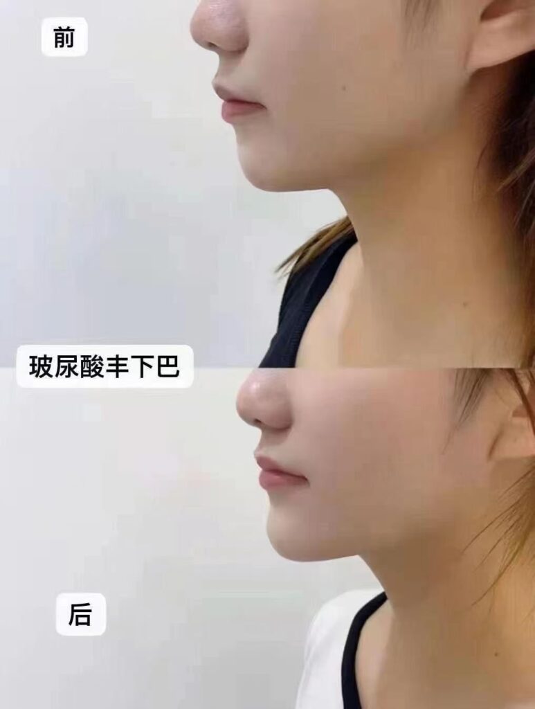 View Angle: Left-Front Oblique 玻尿酸丰下巴 | Dr. Hu Case