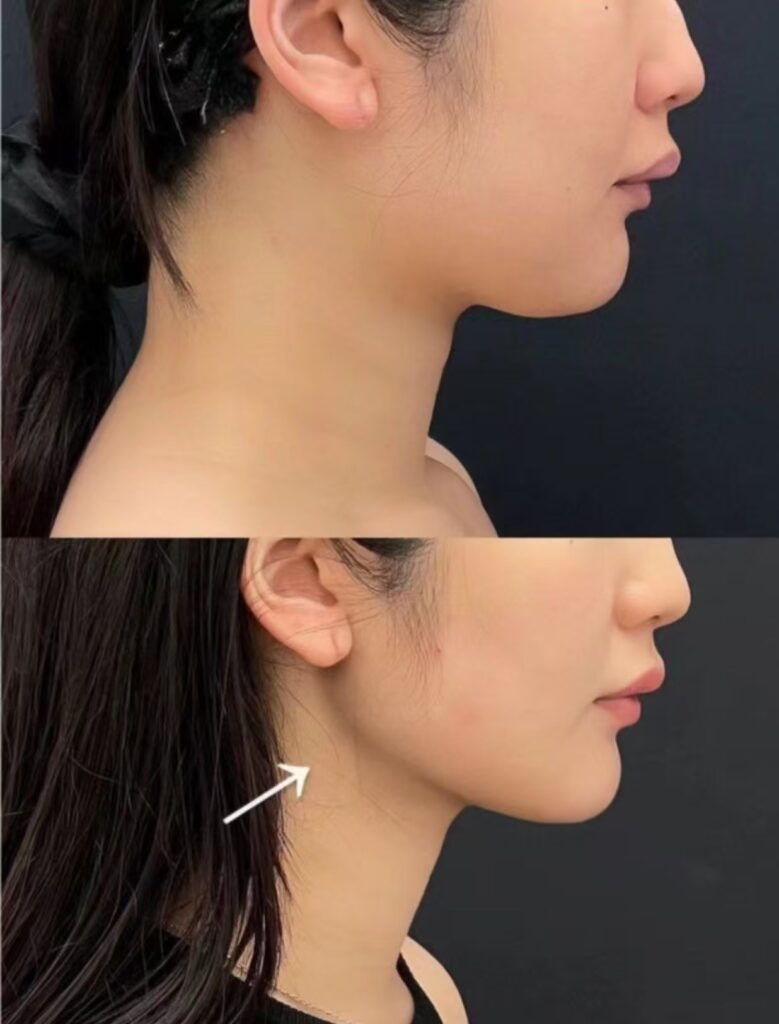 View Angle: Right-Side 玻尿酸丰下巴 | Dr. Hu Case