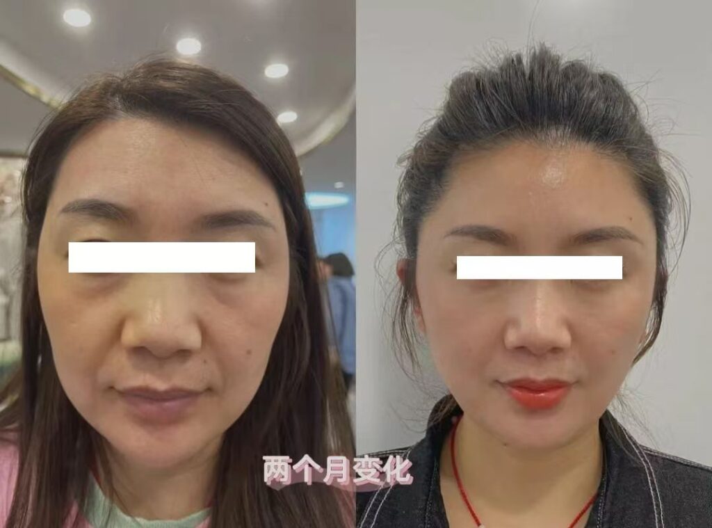 View Angle: Left-Front Oblique 面部提升 | Dr. Hu Case