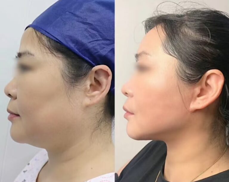 面部提升下颌缘提升 | Dr. Hu Case