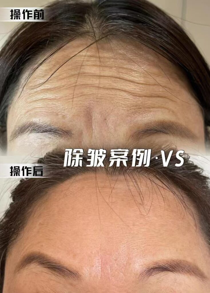 View Angle: Front 额纹除皱 | Dr. Hu Case