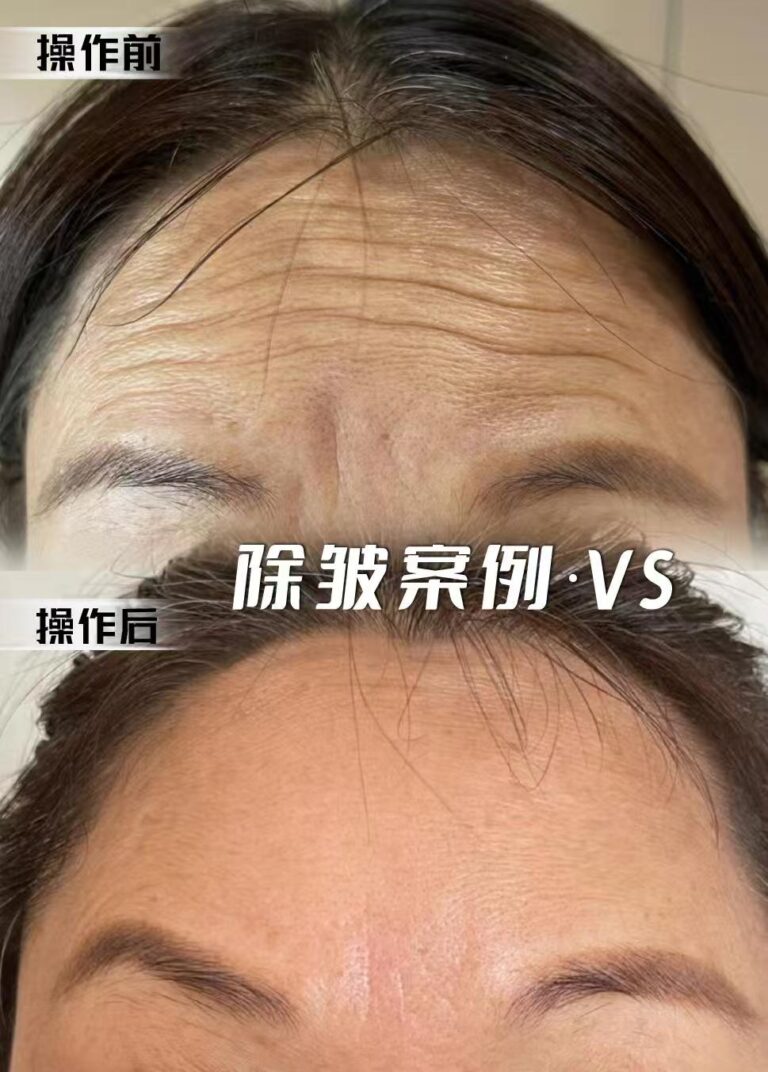 额纹除皱 | Dr. Hu Case