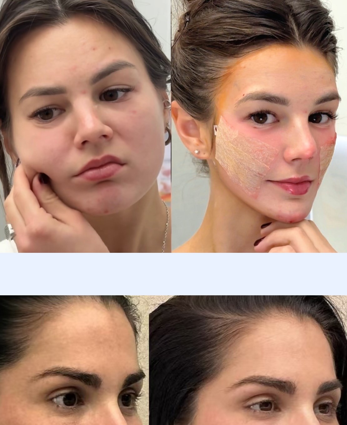 Facial rejuvenation patient before and after