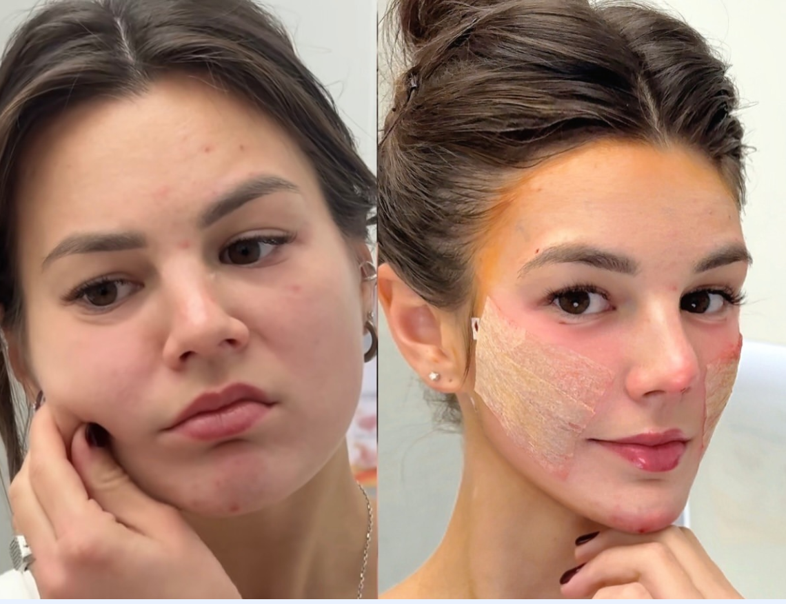 Deep Plane MD facial rejuvenation before and after case gallery