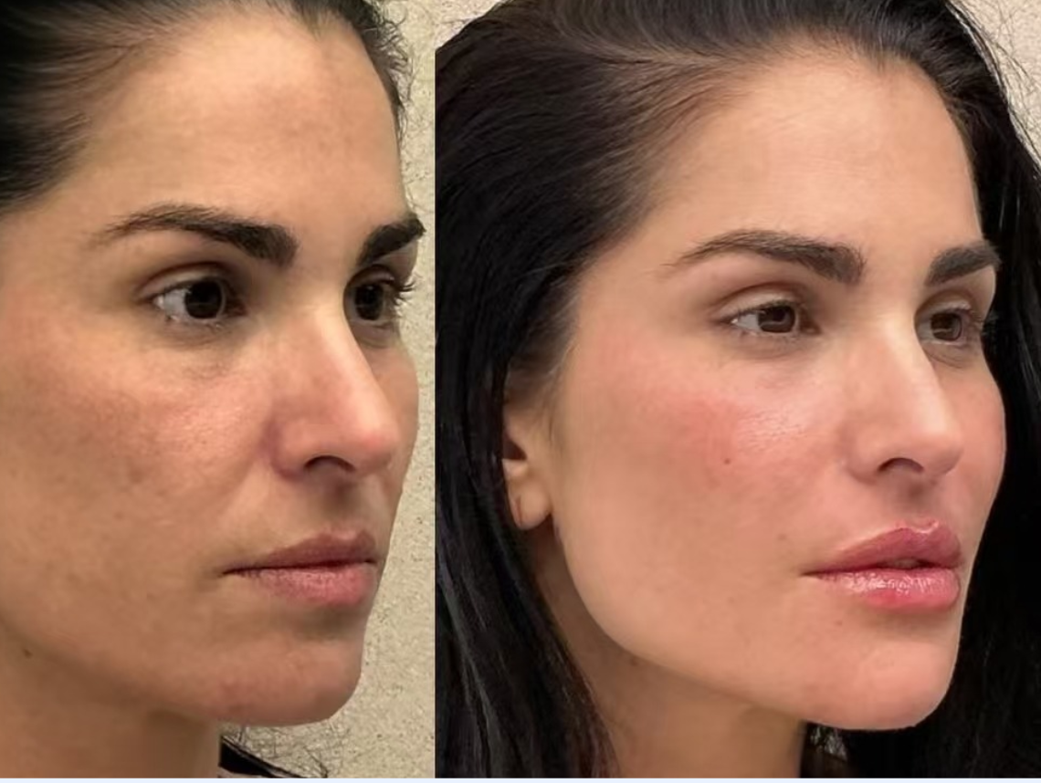 Deep Plane MD facial rejuvenation before and after case gallery
